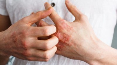 Экзема. (Ternavskaia Olga Alibec/Shutterstock)