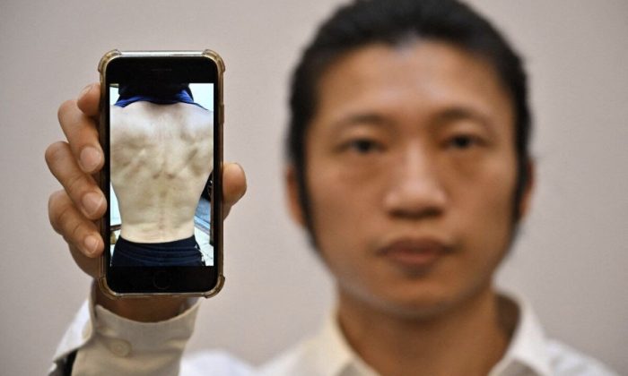 Гонконгский демократический протестующий Боб Чан показывает фотографию на своём телефоне, на которой видны травмы, полученные в результате нападения на консульство Китая в Манчестере, во время демонстрации тремя днями ранее, на пресс-конференции в Лондоне, 19 октября 2022 года. (Ben Stansall/AFP via Getty Images)