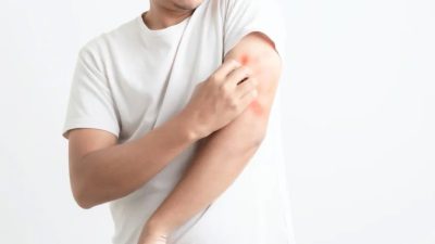 Лечение экземы с помощью ТКМ позволяет предотвратить побочные эффекты при употреблении стероидов. (namtipStudio/Shutterstock)