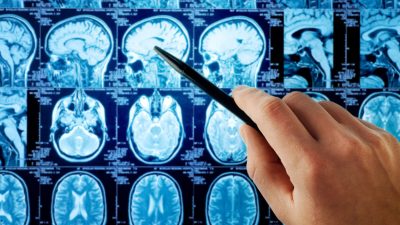 Учёные считают, что COVID вызывает слияние клеток мозга и серьёзно нарушает работу нервной системы. (Triff/Shutterstock)
