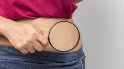 Верные способы избежать растяжек во время похудения